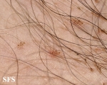 pediculosis pubis