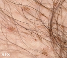 pediculosis pubis