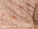 pediculosis pubis