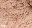 pediculosis pubis