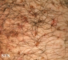 pediculosis pubis