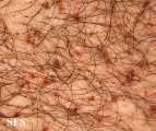 pediculosis pubis