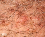 pediculosis pubis