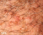 pediculosis pubis