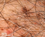 pediculosis pubis