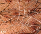 pediculosis pubis