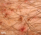 pediculosis pubis