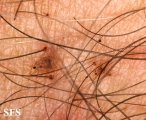pediculosis pubis