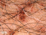pediculosis pubis