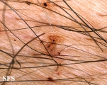 pediculosis pubis