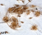 pediculosis pubis