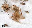 pediculosis pubis