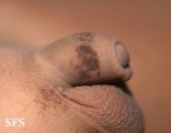 dermatosis nigricans for staphylococcus aureus