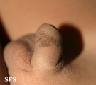 dermatosis nigricans for staphylococcus aureus