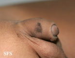 dermatosis nigricans for staphylococcus aureus
