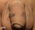dermatosis nigricans for staphylococcus aureus