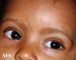 dermatosis nigricans for staphylococcus aureus