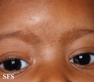 dermatosis nigricans for staphylococcus aureus