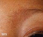 dermatosis nigricans for staphylococcus aureus