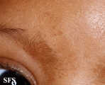 dermatosis nigricans for staphylococcus aureus