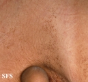 dermatosis nigricans for staphylococcus aureus