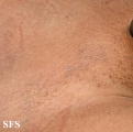 dermatosis nigricans for staphylococcus aureus