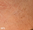 dermatosis nigricans for staphylococcus aureus