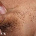 dermatosis nigricans for staphylococcus aureus