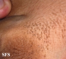 dermatosis nigricans for staphylococcus aureus
