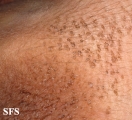dermatosis nigricans for staphylococcus aureus