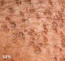 dermatosis nigricans for staphylococcus aureus