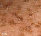 dermatosis nigricans for staphylococcus aureus