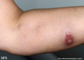 sporotrichosis