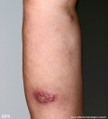 sporotrichosis