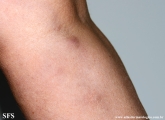 sporotrichosis