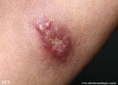 sporotrichosis