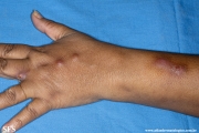 sporotrichosis