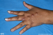 sporotrichosis