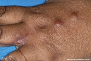 sporotrichosis