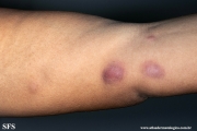sporotrichosis