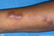 sporotrichosis