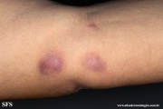 sporotrichosis