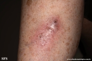 sporotrichosis
