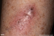 sporotrichosis