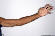 sporotrichosis