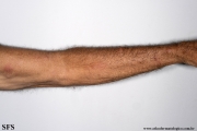 sporotrichosis