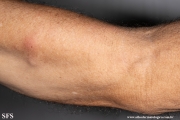 sporotrichosis