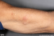sporotrichosis