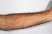 sporotrichosis