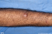 sporotrichosis